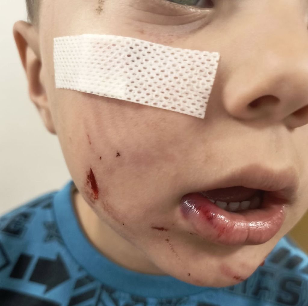 4-Letni Franio Pogryziony Przez Psa W Ustroniu. Właściciel Psa Uciekł