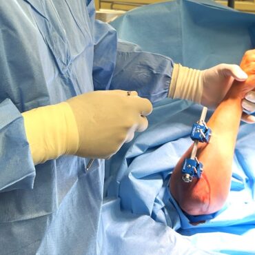 wydłużanie kości Szpital Pediatryczny Bielsko-Biała